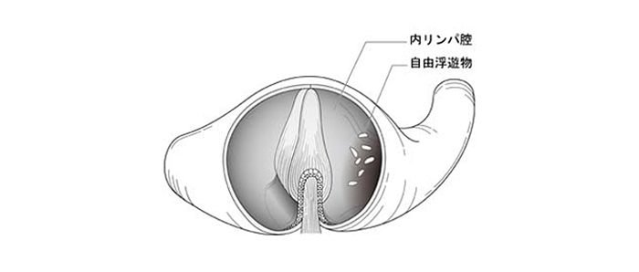 半規管結石