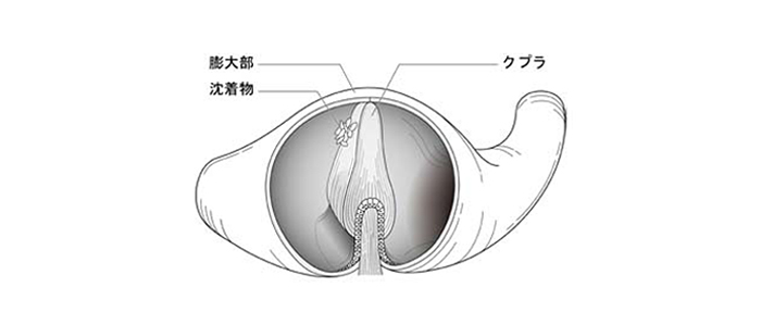 クブラ結石