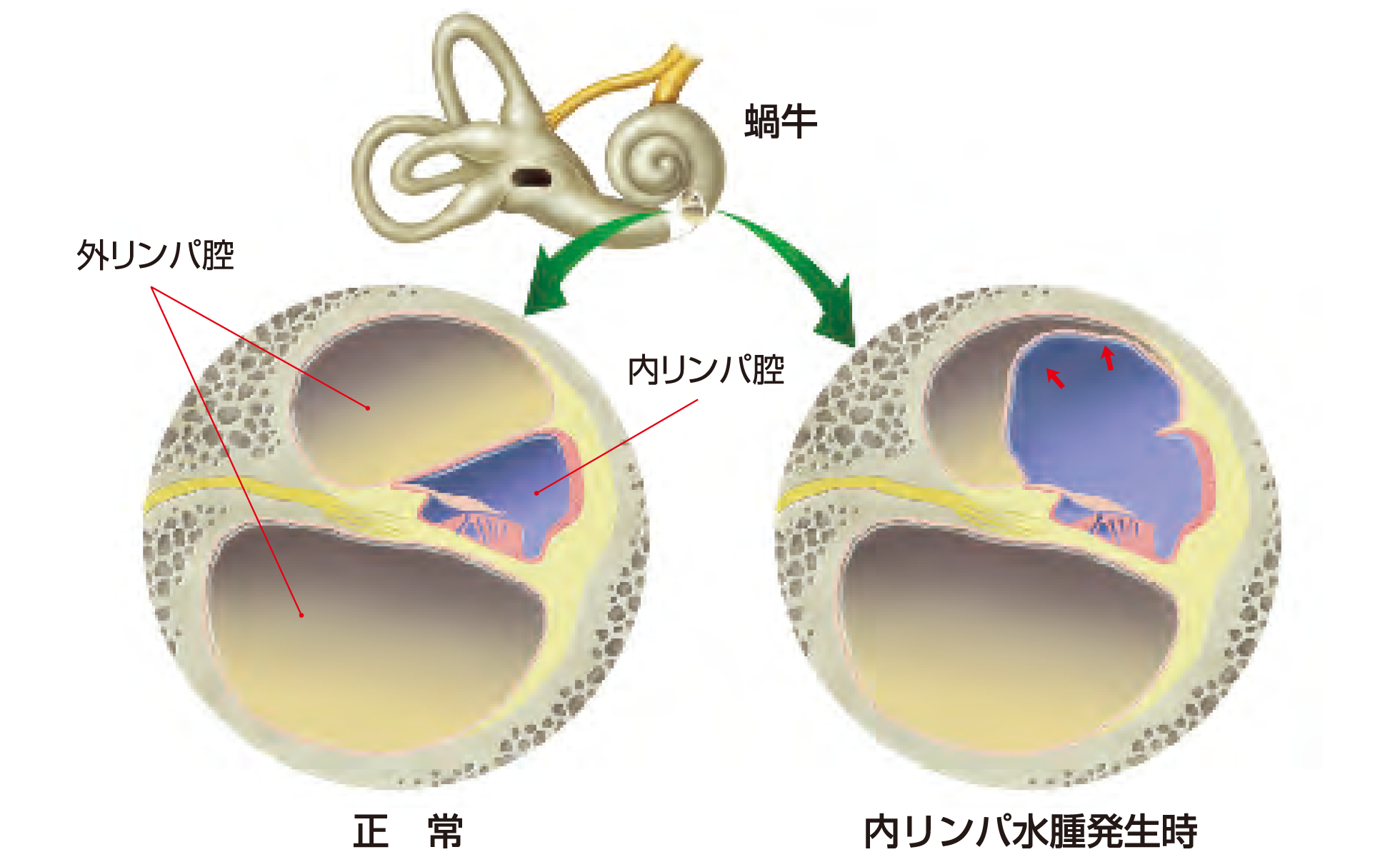 内リンパの貯留